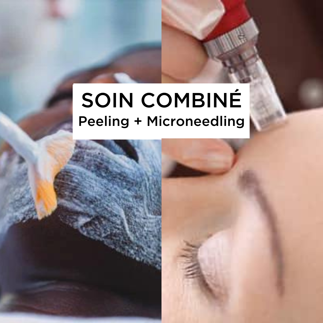 Soin combiné Peeling et Microneedling 160€